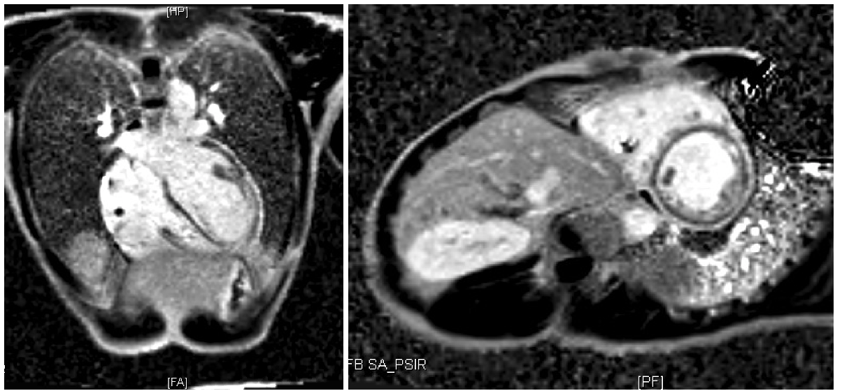 Arrhythmogenic Desmoplakin Cardiomyopathy Cardionerds