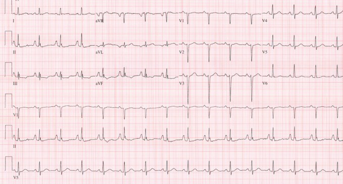 CardioNerds ECG Challenge #7 : ST segment abnormalities- Cardionerds