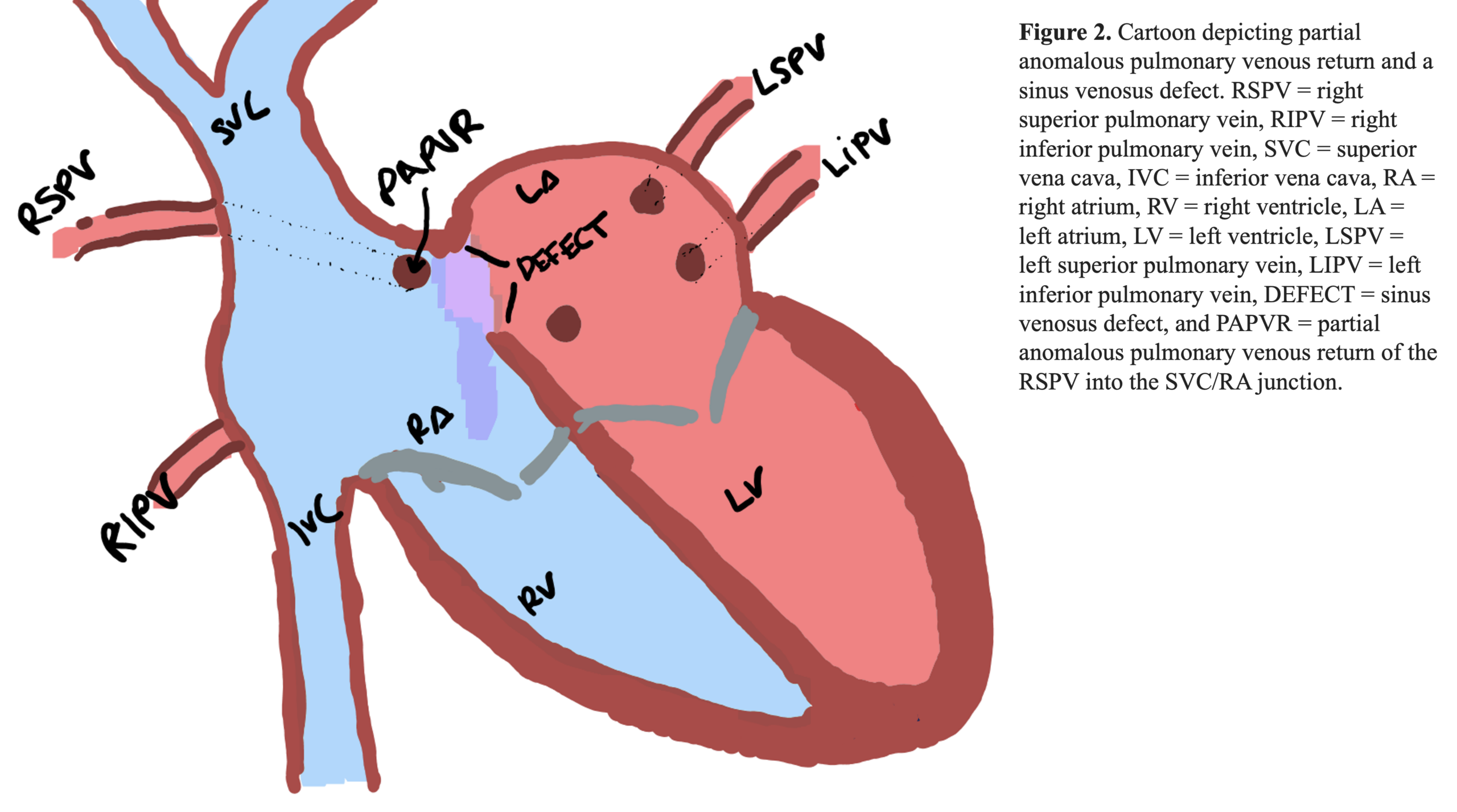 sinus-venosus-defect-with-partial-anomalous-pulmonary-venous-return