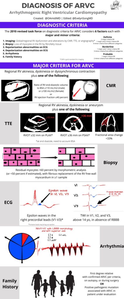 Diagnosis of ARVC